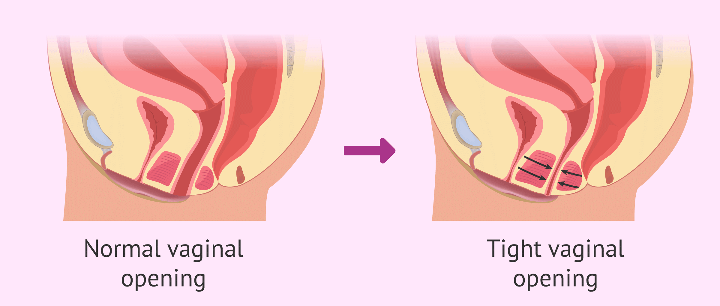 Gynae Oncology